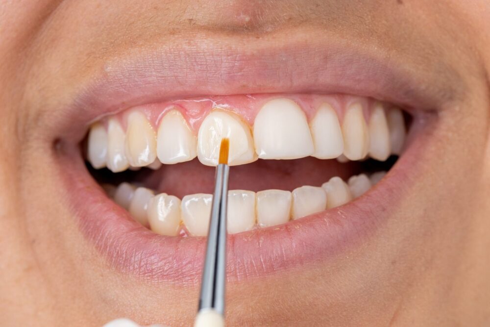 Композитен бондинг