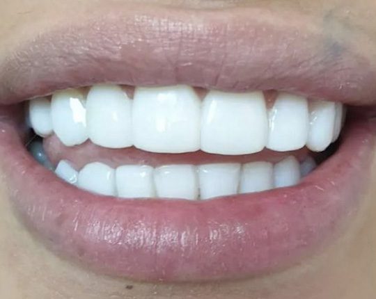 Метод Бондинг